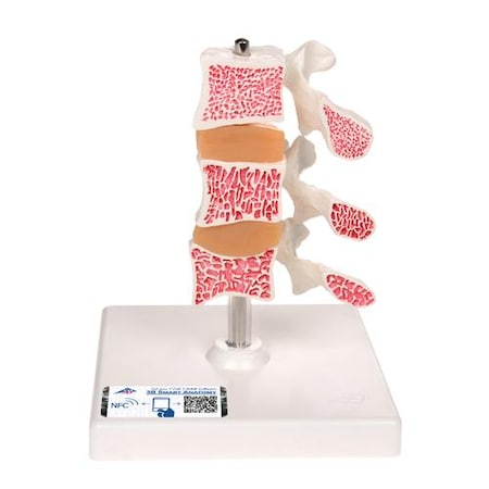 Deluxe Osteoporosis Model - W/ 3B Smart Anatomy